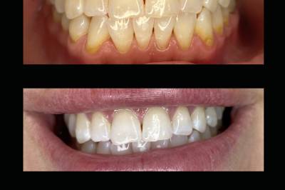 Reno's Best Wedding Whitening