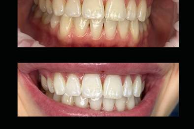 Reno's Best Wedding Whitening