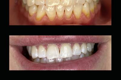 Reno's Best Wedding Whitening