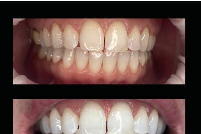 Reno's Best Wedding Whitening