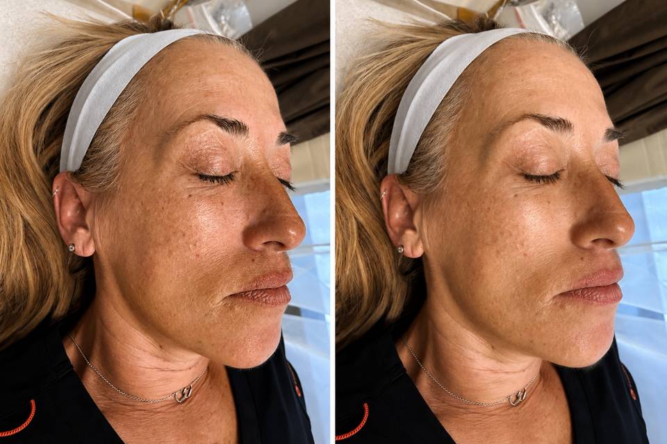 Glo2 facial