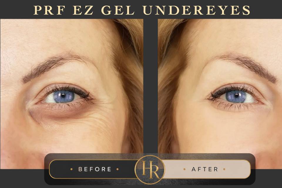 PRF EZ GEL under eyes