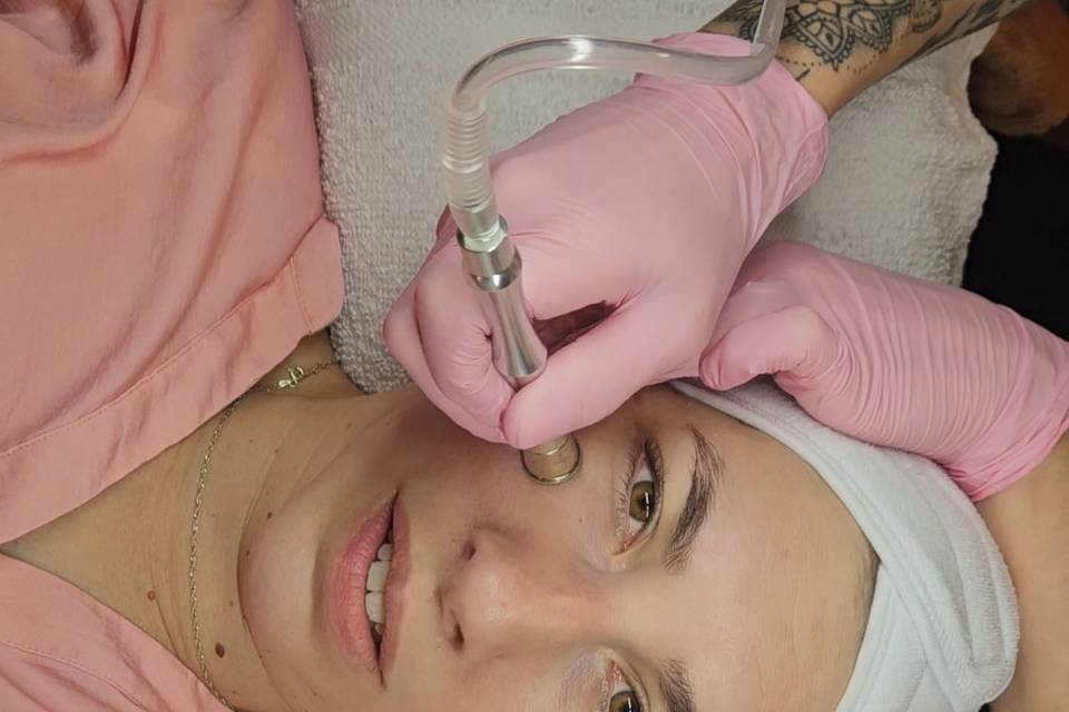 Diamond dermabrasion facial