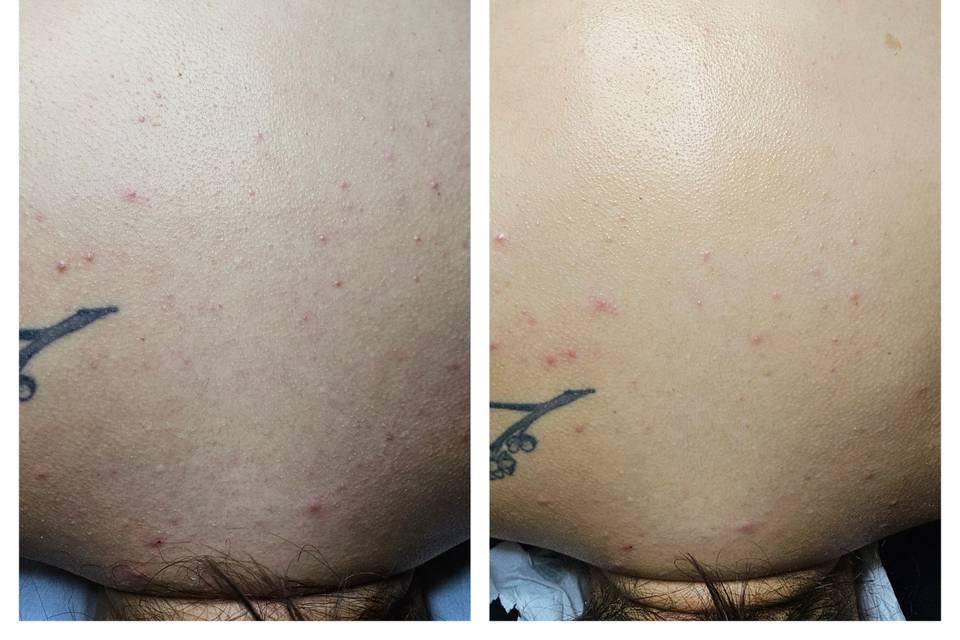 Back facial