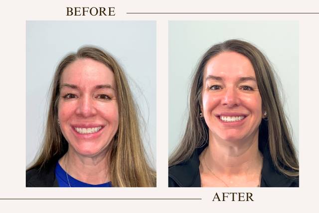 Before and after whitening