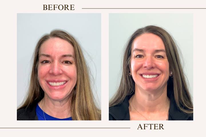 Before and after whitening