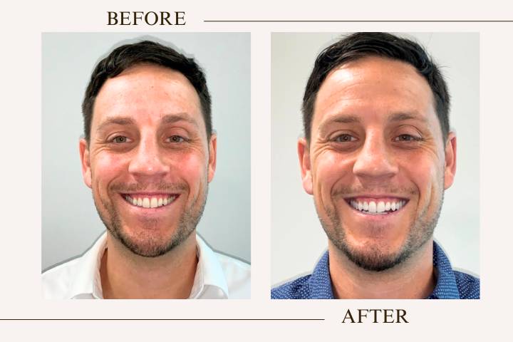 Before and after whitening