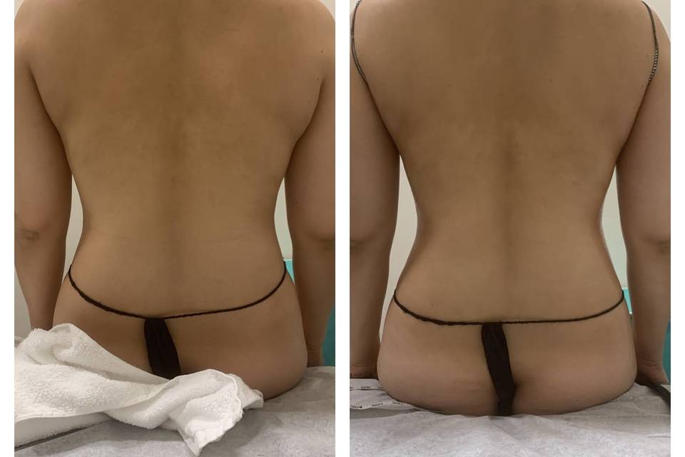 Lower back body contouring