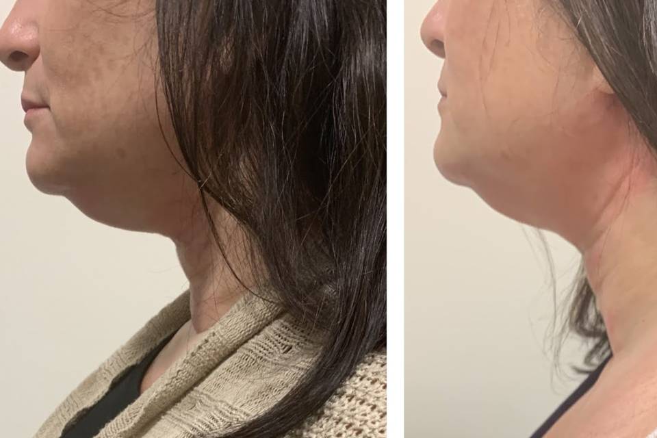 3 under the chin treatments