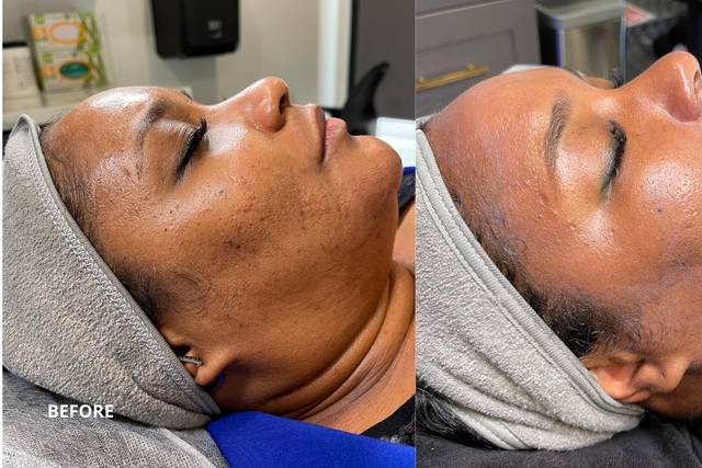 HydraFacial - Acne Scars