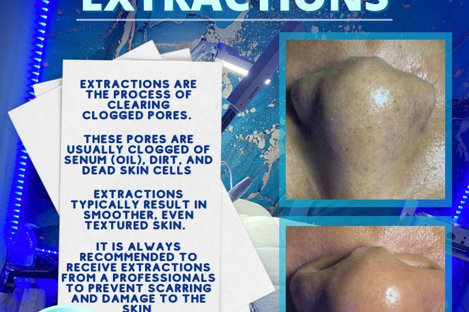 Extractions