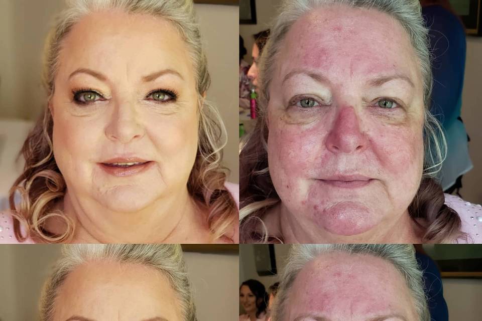 B&A Skin Correction