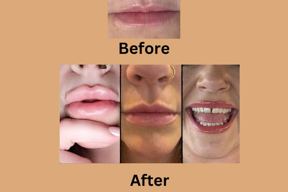 Lip Filler Transformation