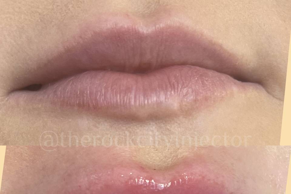 Lip Filler