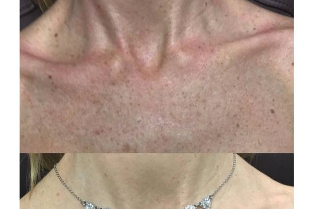 Before and after BBL treatment