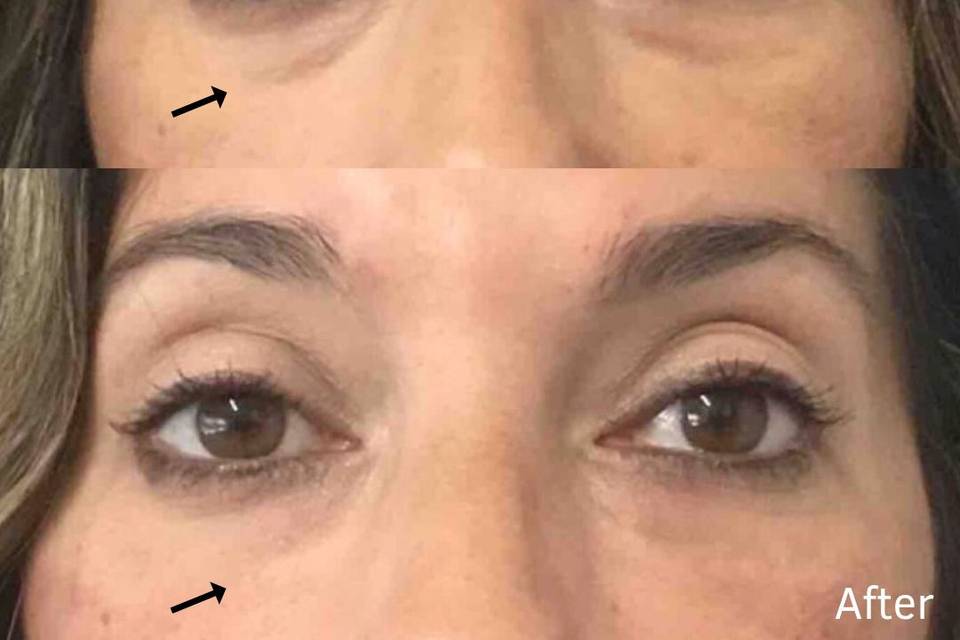 Before and after under-eye filler