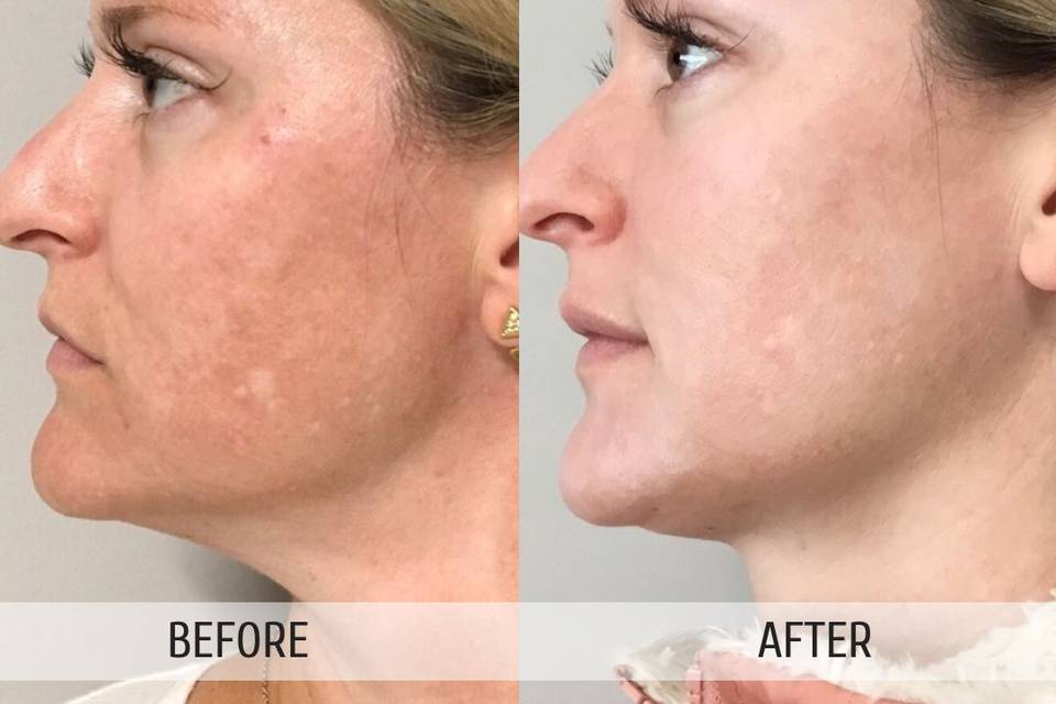 Before and after halo treatment