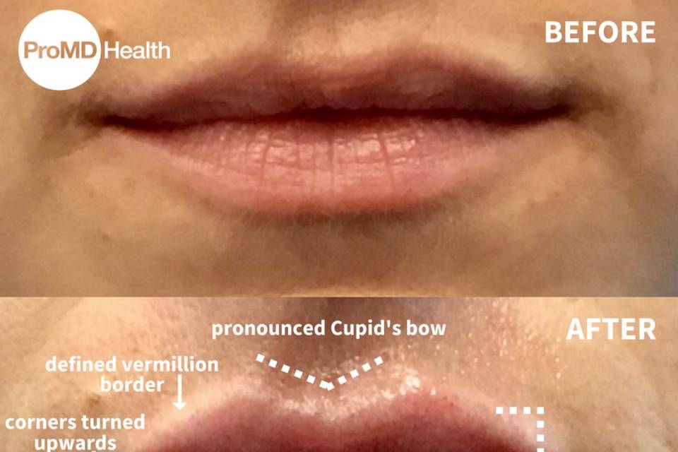 Before and after lip filler