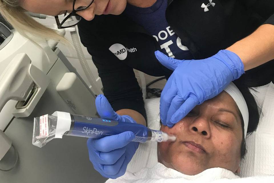 Microneedling treatment