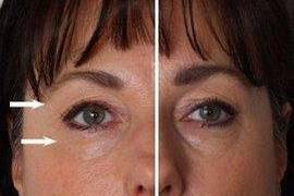 One half of her face was done for 60 days.