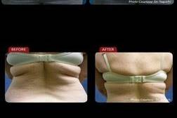 the low-level laser is used for a total of 40 minutes. The laser is applied to the targeted area, which is generally a combination of the waist, hips, and thighs, for 20 minutes. The patient then turns over and the very same treatment is applied to the opposite side. The minimum suggested treatment period is two weeks, with three full sessions each week. You should consult with us about the maximum results for your body type, weight, and target loss.