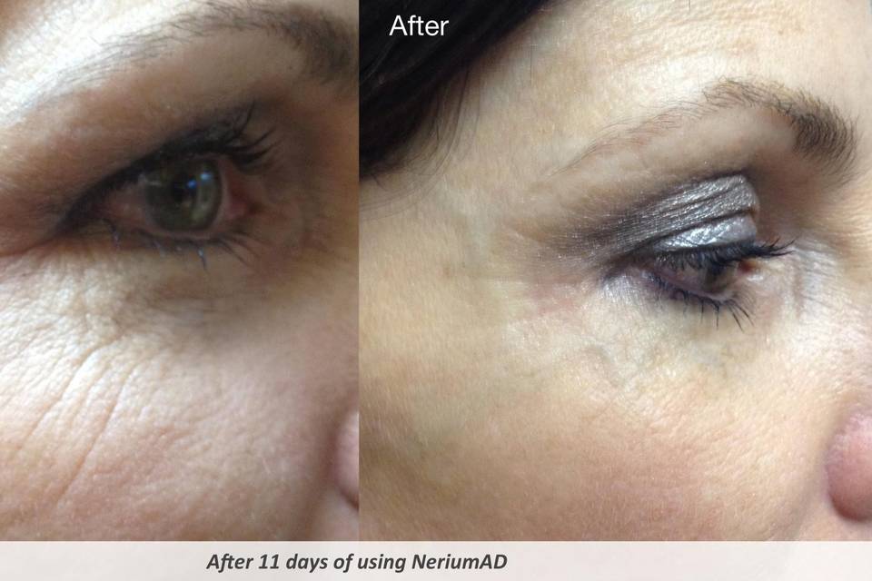 11 day results with our night cream!!