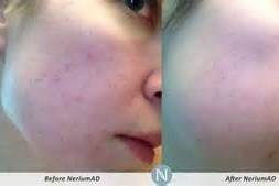 6 day results with our night cream to help with acne!!