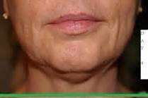 90 day results with our night cream applied to the face and neck!!