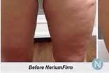30 day results with our firm lotion twice a day, no special diet or exercise!!