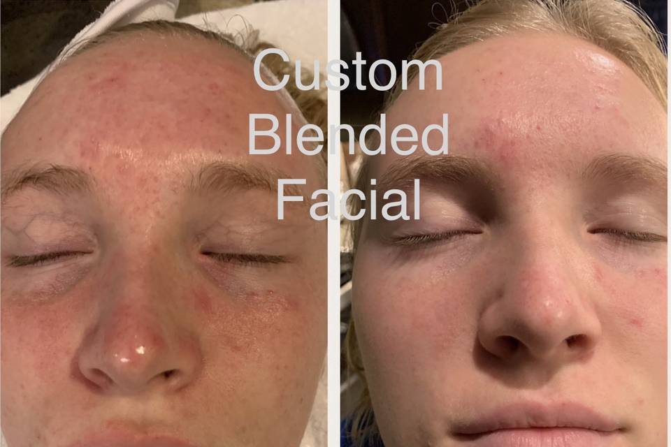 Custom blended facial