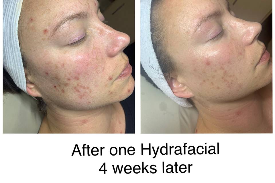 Hydrafacial