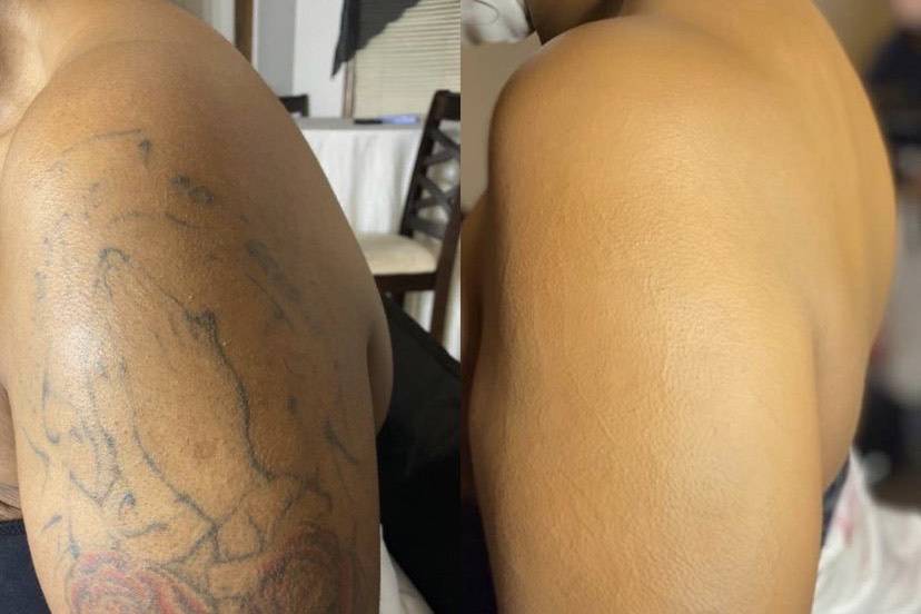 Tattoo cover up