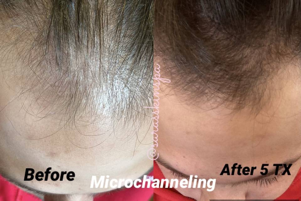 Microchanneling for thinning