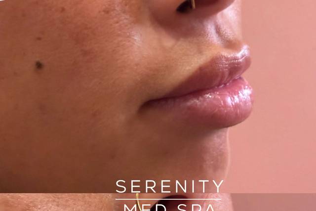 Lip Filler