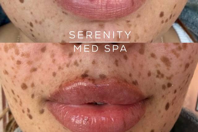 Lip Filler