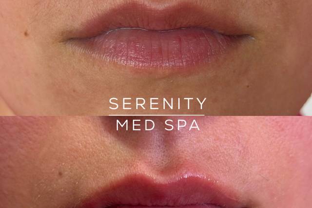 Lip Filler