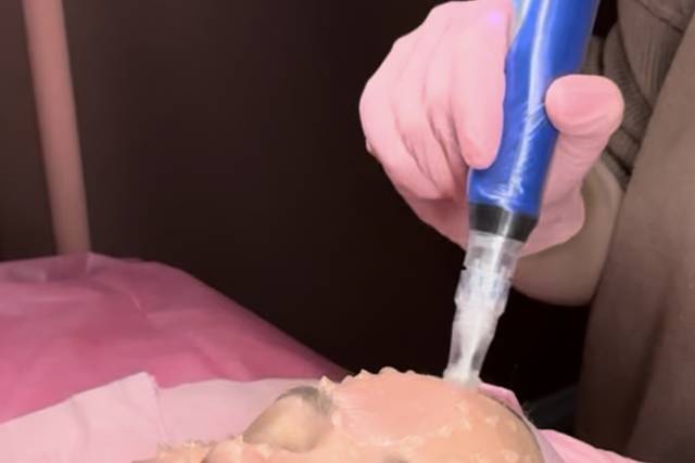 Microneedling