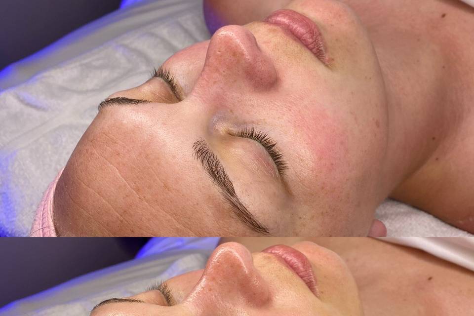 HydraFacial