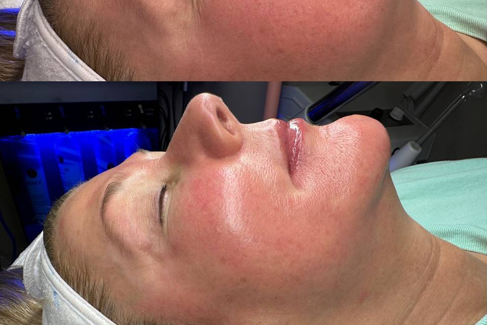 Light Peel and Facial