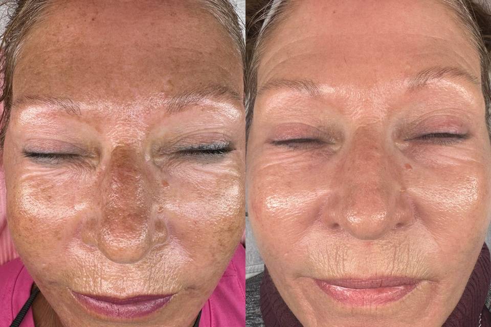 Facial & Laser