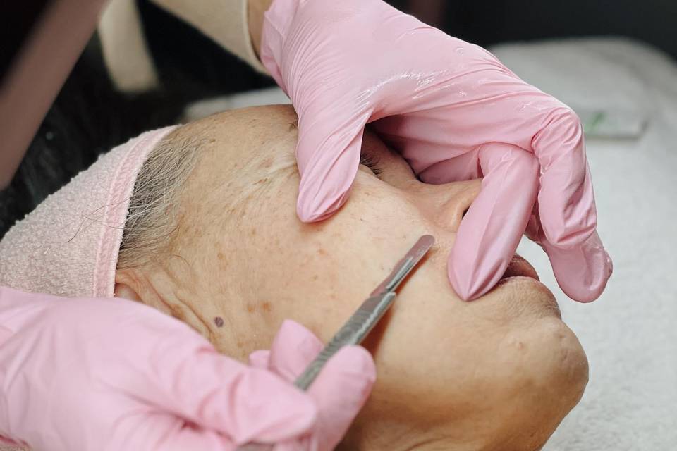Dermaplaning