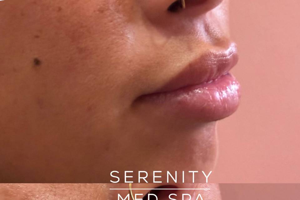 Microneedling