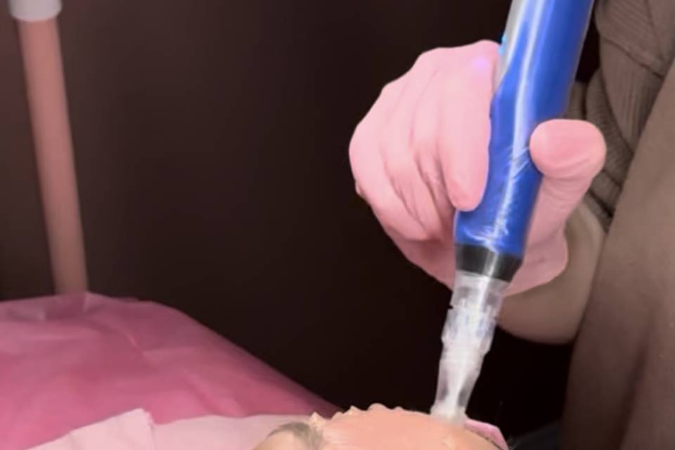 Lip Filler