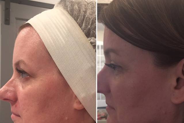 After the procedure