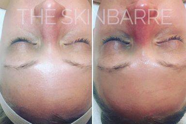 The SkinBarre