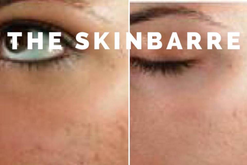 The SkinBarre