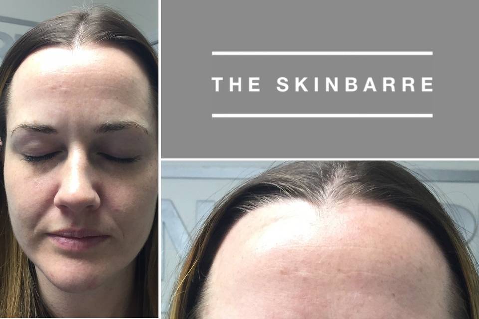 The SkinBarre