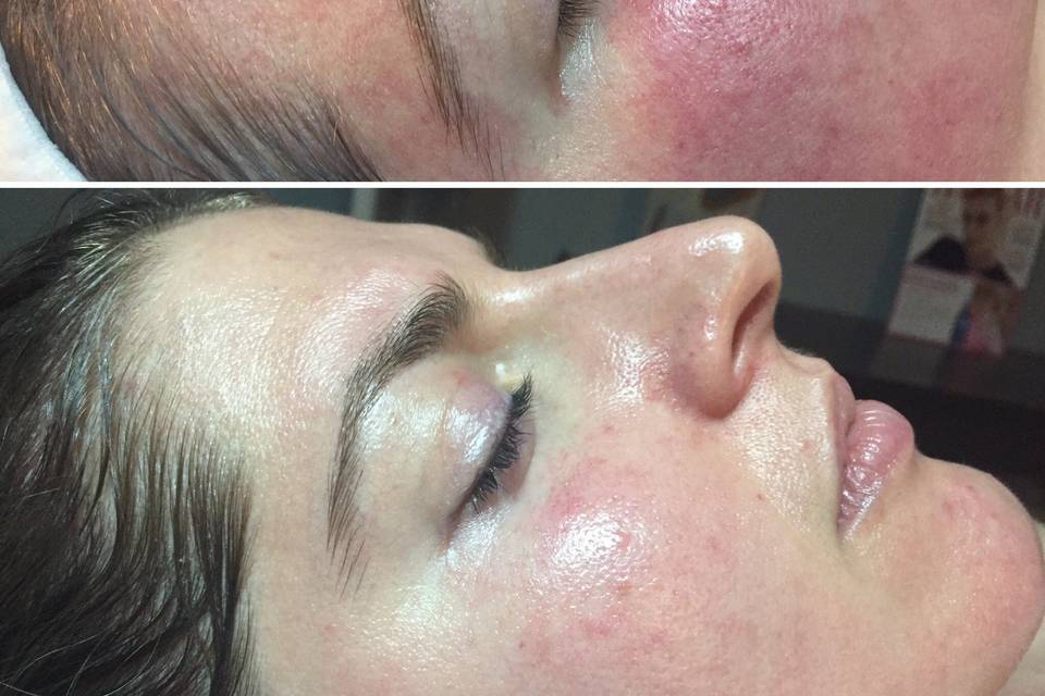 Facial