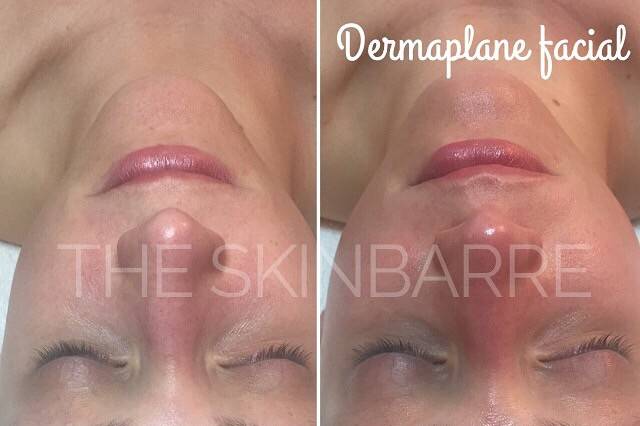 Dremaplane facial