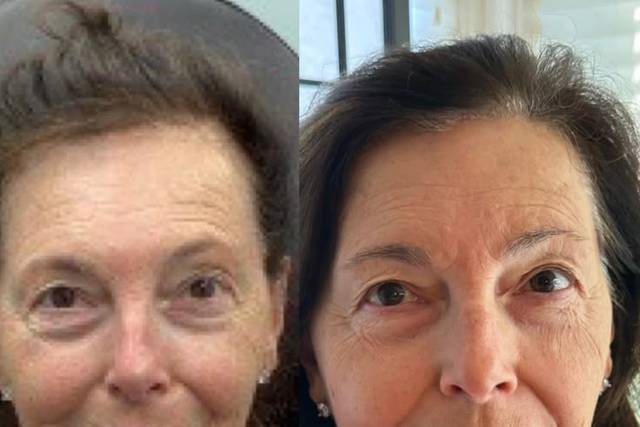 Before and After